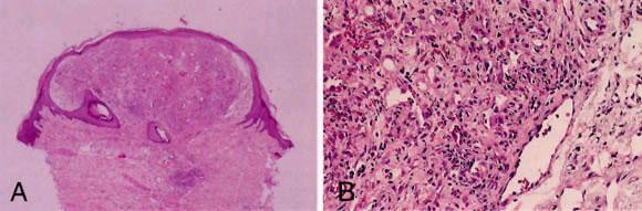Pyogenic Granuloma DDX Bacillary angiomatosis Clinical history Neutrophils adjacent to