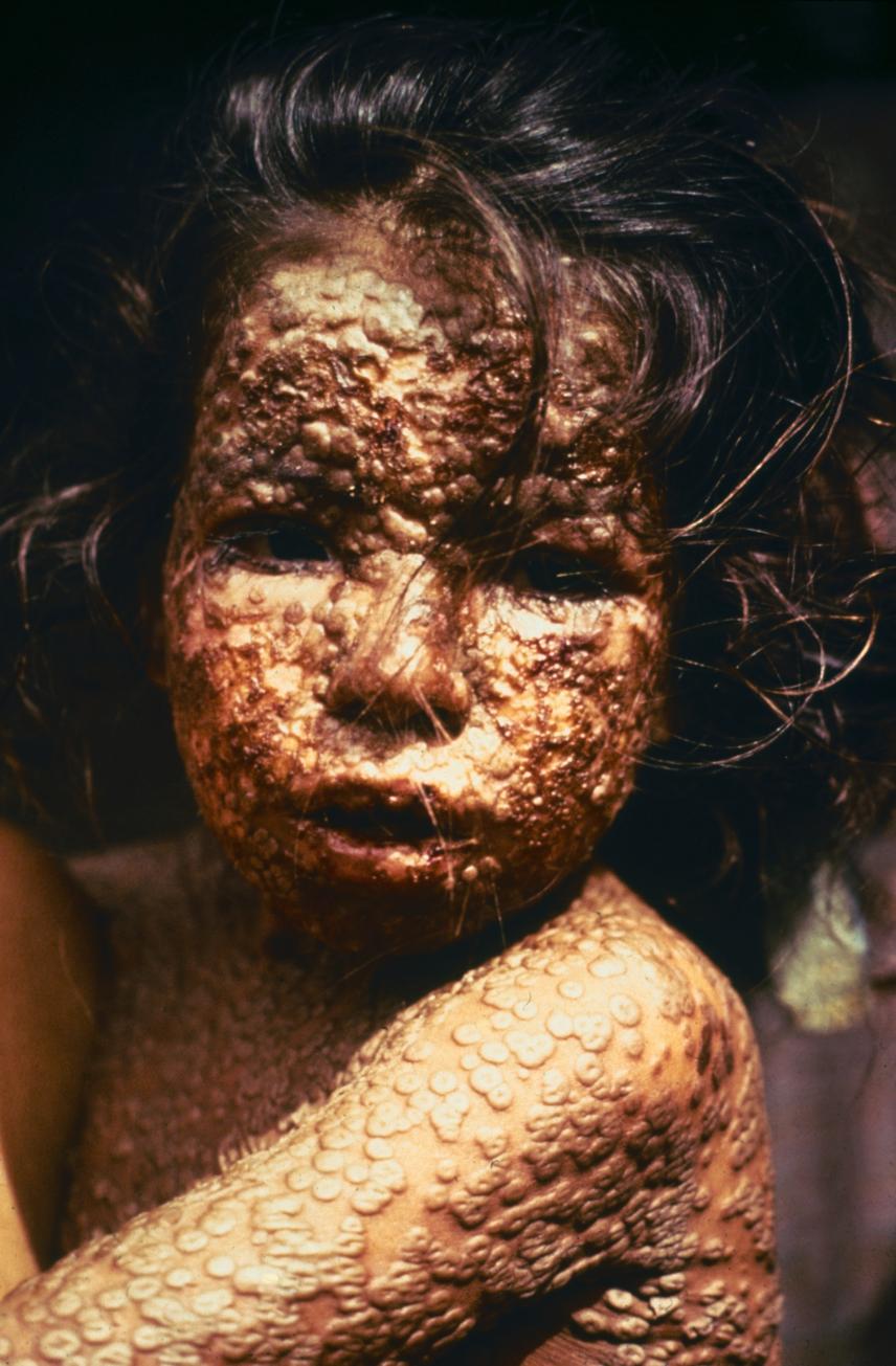 Smallpox Smallpox was an infectious disease caused by one of two virus variants, Variola major and Variola minor.