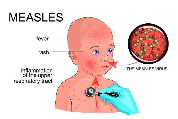Rubella and Measles Rubella is a contagious, generally mild viral infection that occurs most often in children and young adults.