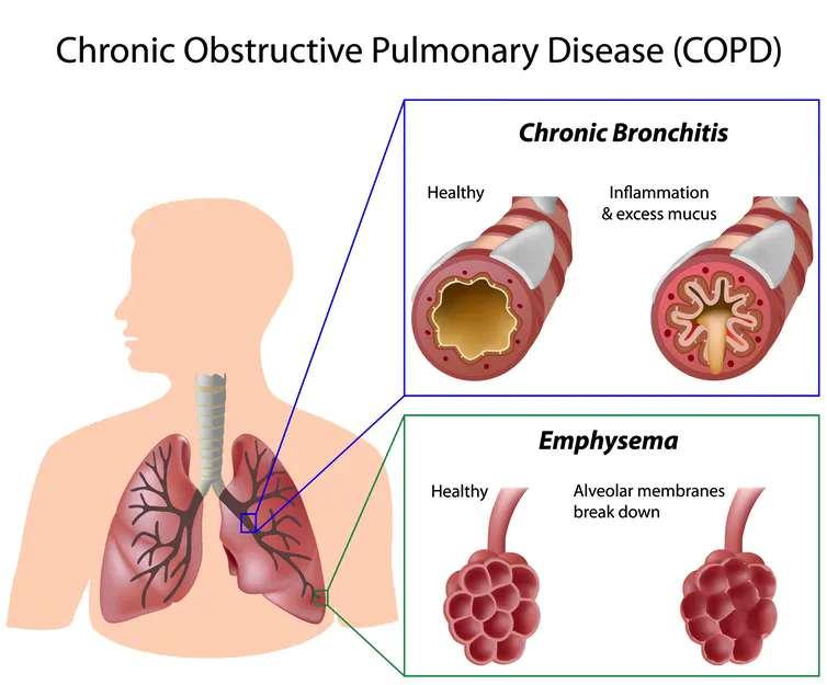 Chronic obstructive pulmonary disease Chronic obstructive pulmonary disease (COPD) is a chronic inflammatory lung disease that causes obstructed airflow from the lungs.
